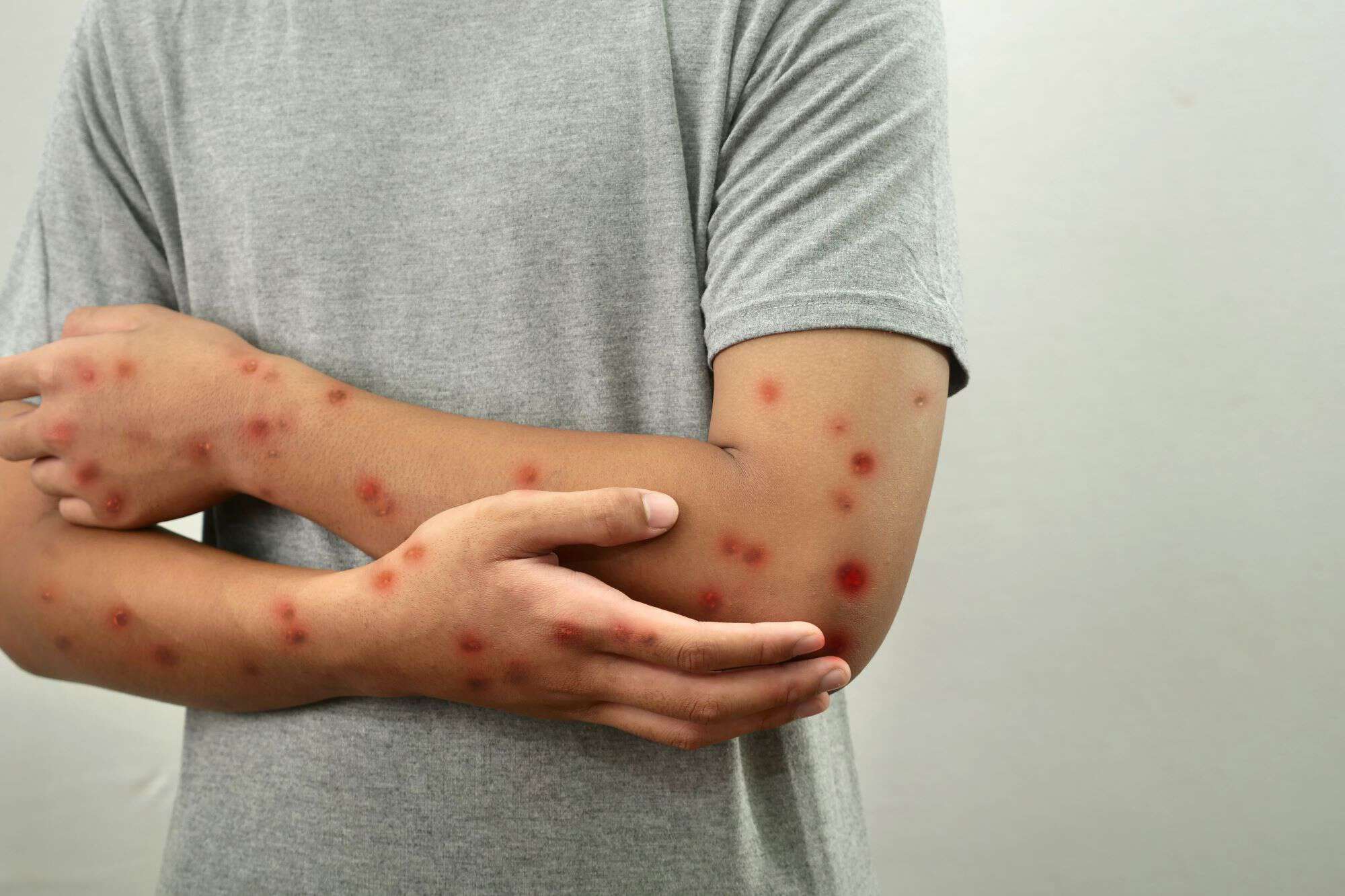 Brasil mantém vigilância contra mpox após novos casos confirmados, informa Ministério da Saúde
