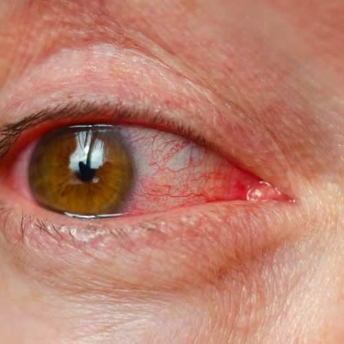Olhos ardendo e visão embaçada? Tempo seco pode estar por trás do problema
