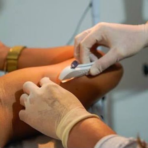 Implanon no SUS em Goiás: saiba como funciona e quem pode ter acesso