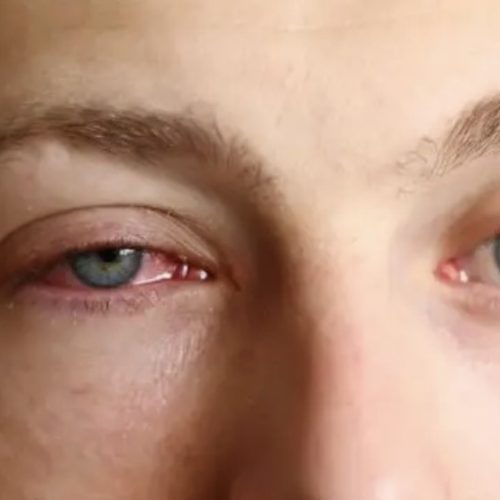 Carnaval acende alerta para aumento de casos de conjuntivite viral