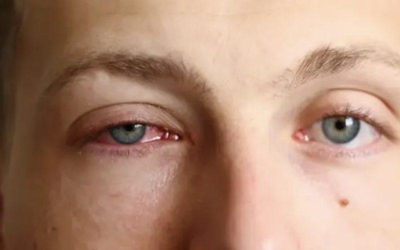 Carnaval acende alerta para aumento de casos de conjuntivite viral