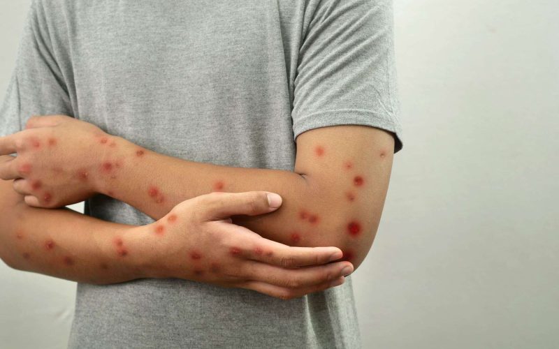 Brasil mantém vigilância contra mpox após novos casos confirmados, informa Ministério da Saúde