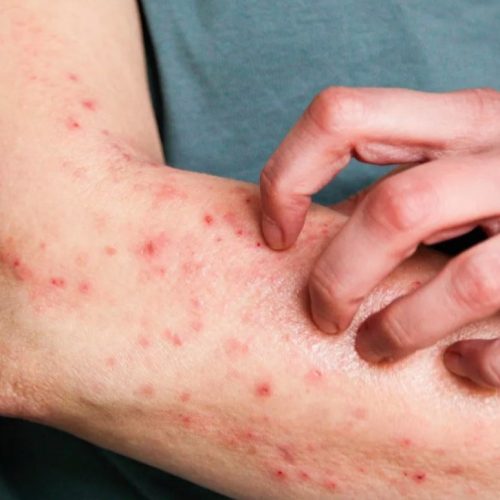 Goiás Investiga Cinco Casos Suspeitos de Mpox em 2026